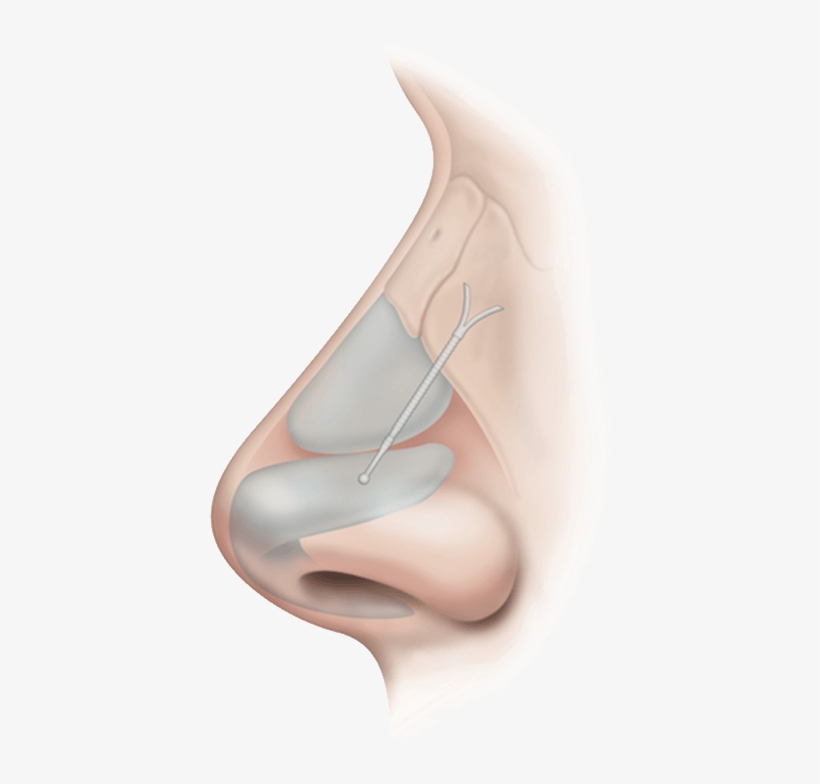 Absorbable Nasal Implant - Stryker Corporation, transparent png download