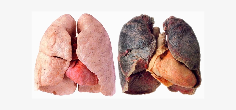 Healthy Lung And Smokers Lung - Kick Smoking And Kick Cancer: Fastest And Best Guide, transparent png download
