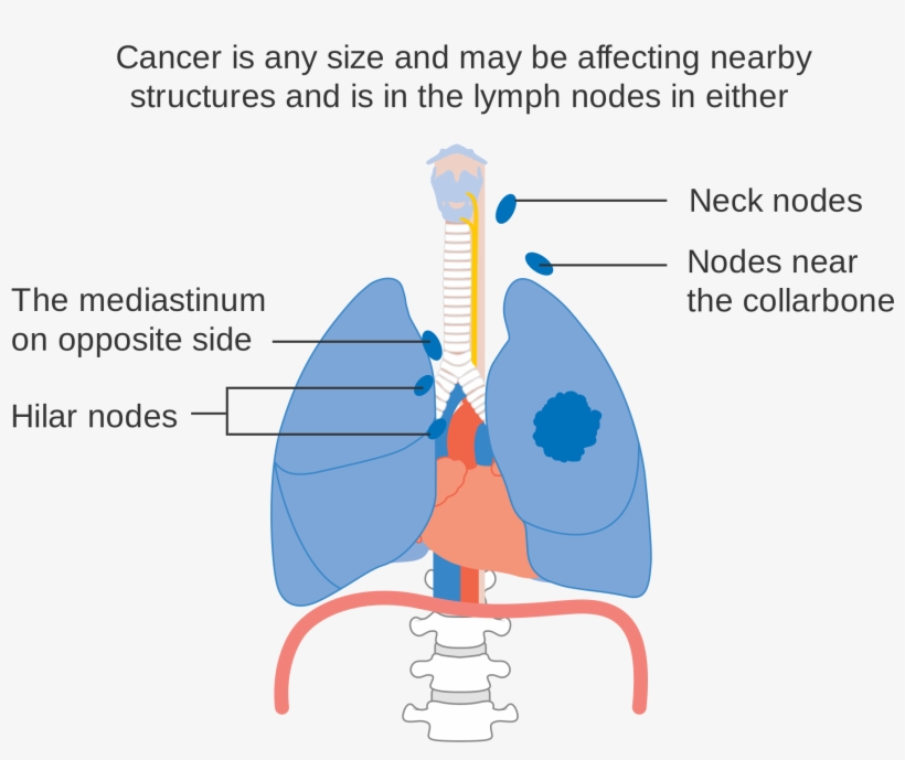Open - Lung Cancer, transparent png download