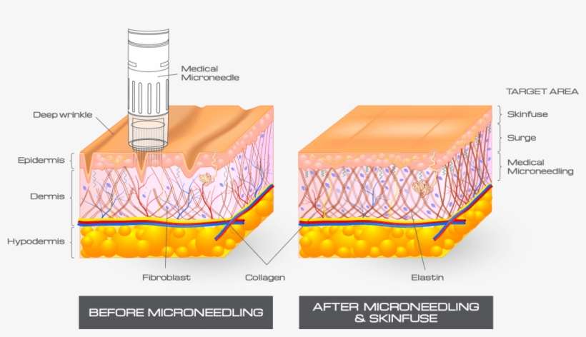 Micropuncion Gold Pen De Dermica Nuevo Concepto De - Fibroblast Layer Of Skin, transparent png download
