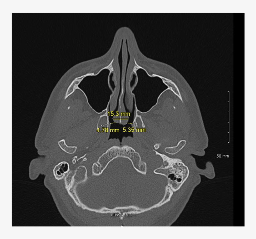 Axial Cut Computed Tomography Image Showing Mucosal - Computed Tomography, transparent png download