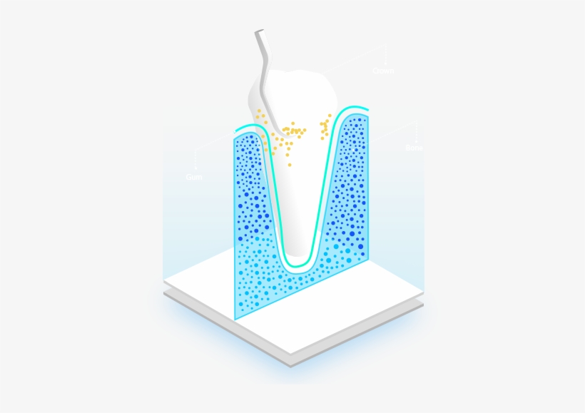 Raspado Radicular Deep Cleaning - Dental Implant, transparent png download