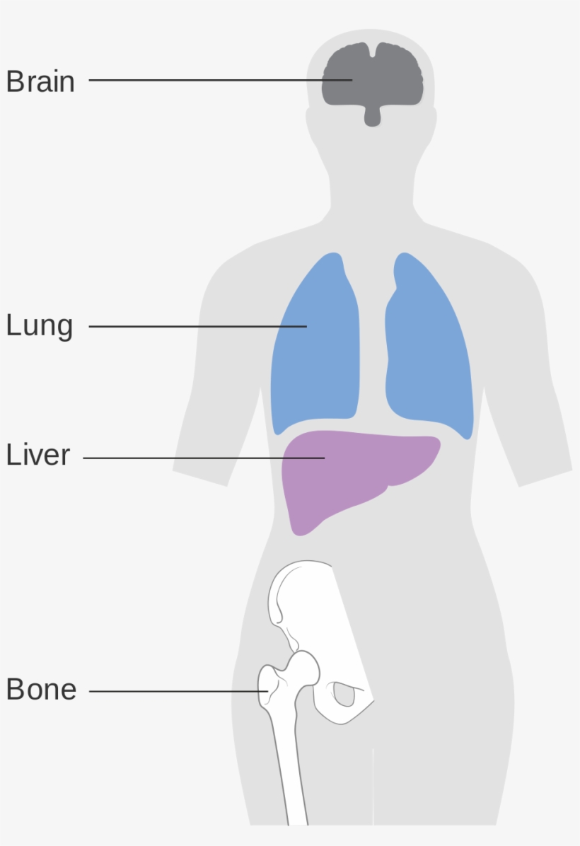 Breast Cancer Metastasis Site, transparent png download