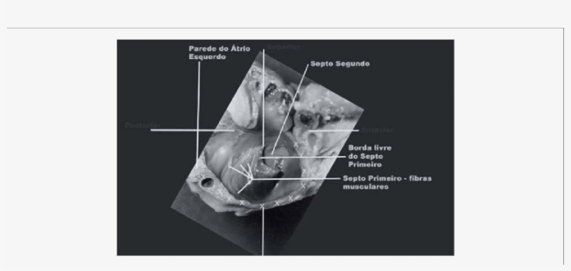 Forame Oval Visto Do Átrio Esquerdo - Foramen Ovale, transparent png download