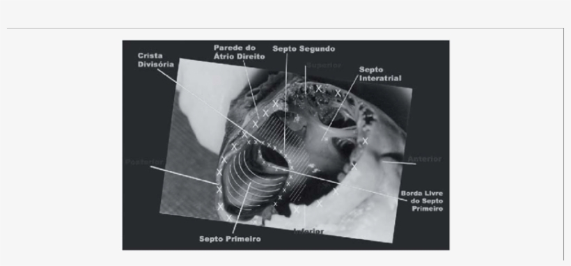 Forame Oval Visto Do Átrio Direito Para O Átrio Esquerdo - Atrium, transparent png download