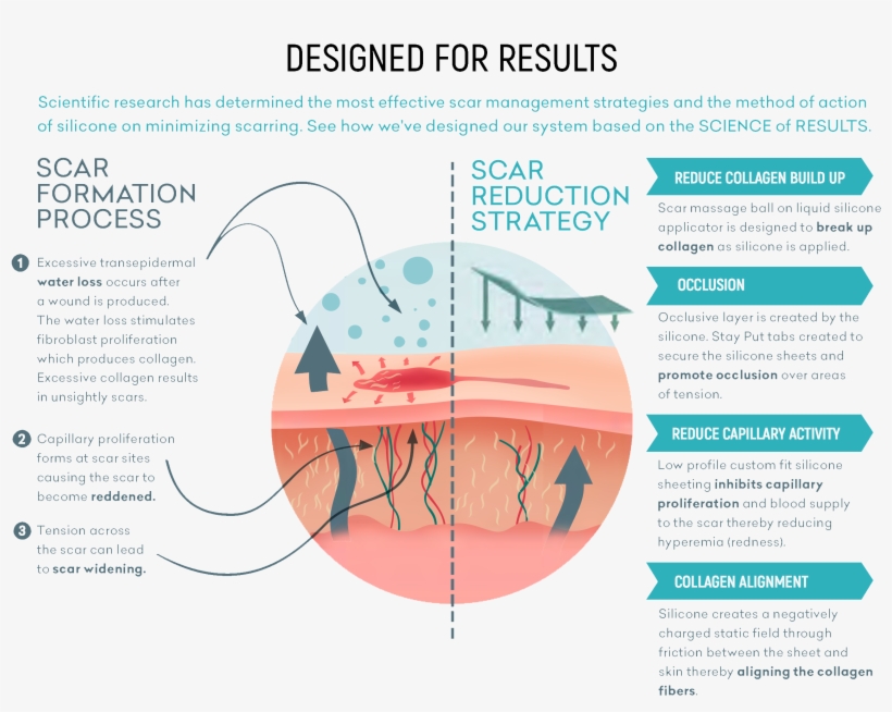 How Fade Away Silicone Works On Scars - Diagram, transparent png download