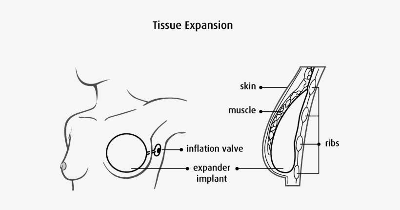 Types Of Breast Reconstruction, transparent png download