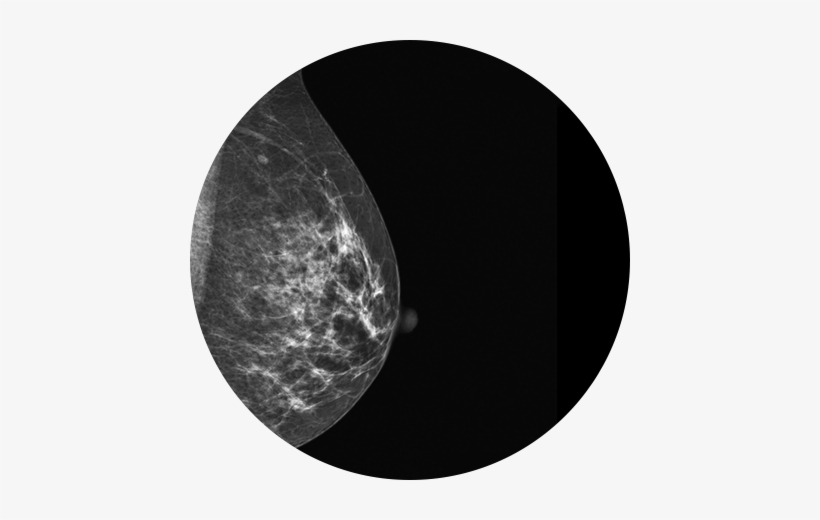 Breast Imaging - Thread Veins In Breast On Mammogram, transparent png download
