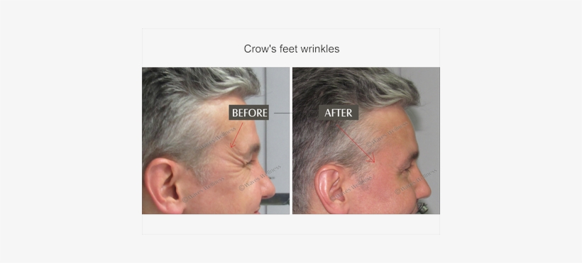 Wrinkle Correction - Wrinkle, transparent png download