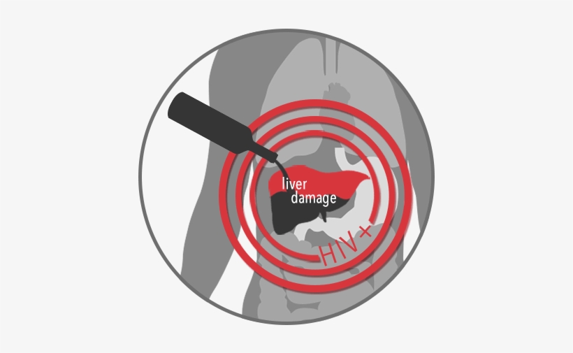 Alcohol Damages The Liver - Hiv/aids, transparent png download
