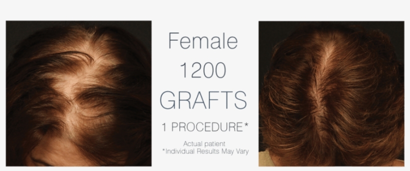 Hair Transplant Cost - Hair Transplantation, transparent png download