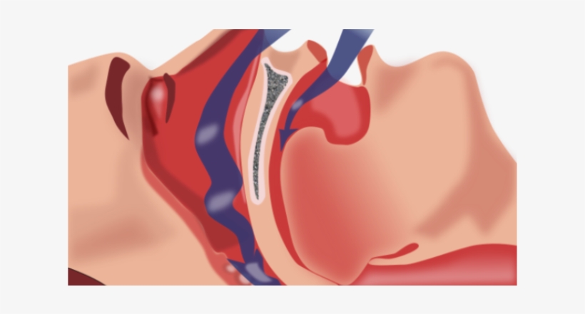 Brain Damage Caused By Severe Sleep Apnea Is Reversible - Upper Airway Cross Section, transparent png download