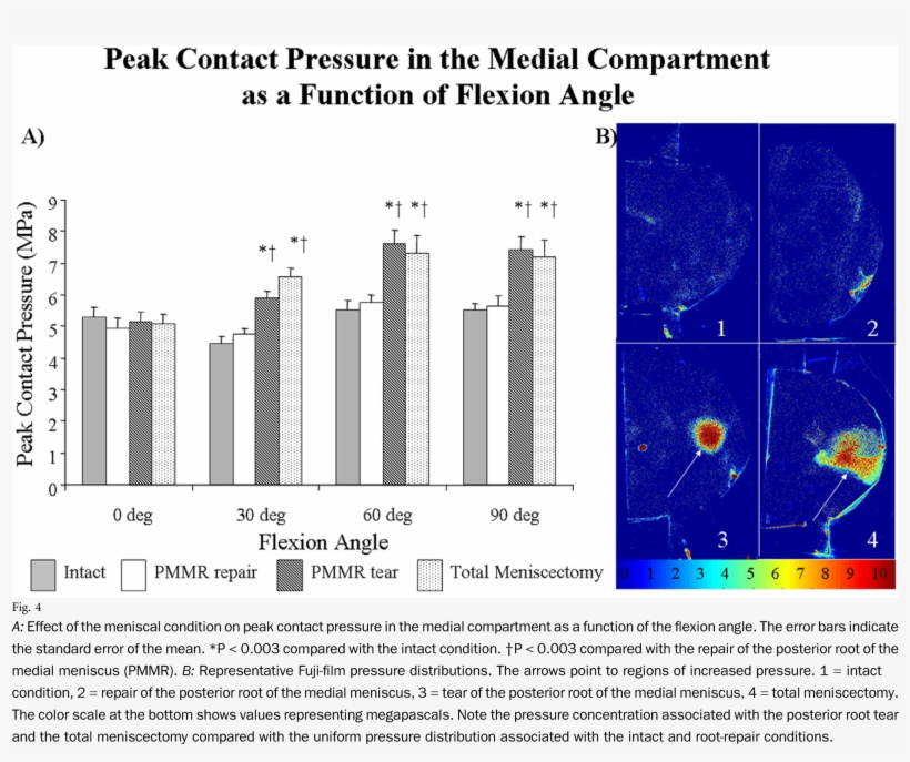 Effect Of The Meniscal Condition - Biomechanics Fuji Film Pressure Cadaver, transparent png download
