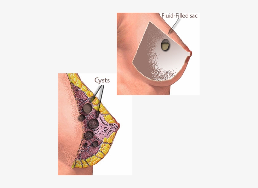 5girq5i15c8 Ds 179161 80 Dx358 Dy358 Cx179 Cy161 - Fibroadenoma De Seno, transparent png download