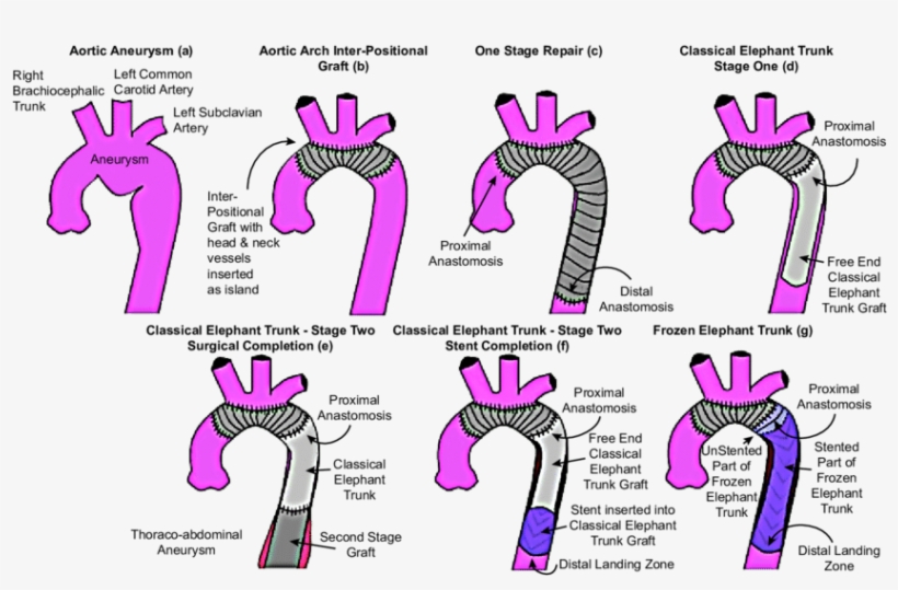 Graphical Representation Of Different Techniques For - Frozen Elephant Trunk Aorta, transparent png download