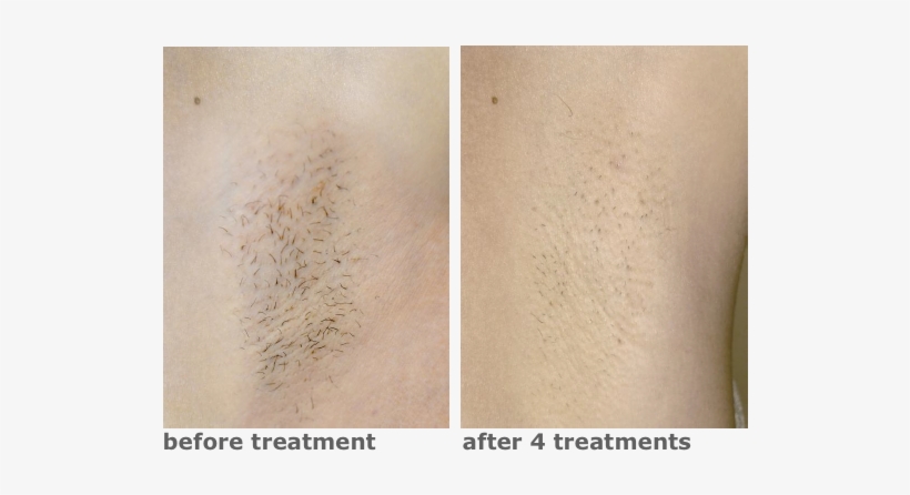 Mediostar Next Diode Laser Hair Reduction Before And - Hair Extensions Before And After, transparent png download