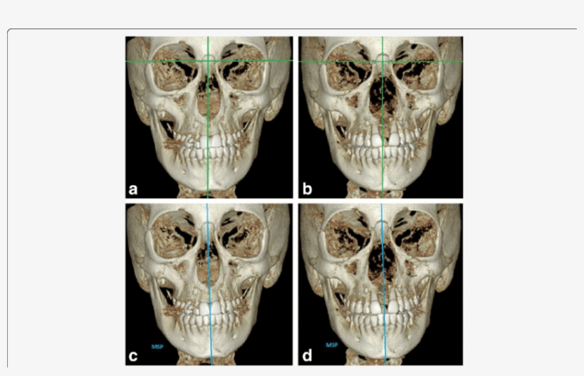 Reference Lines Used In Conventional 2d Postero Anterior - Cephalometric Analysis, transparent png download