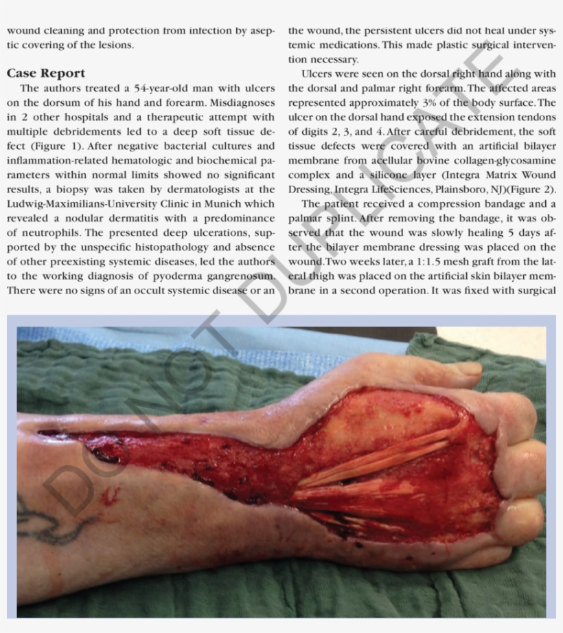 Preintervention, Intraoperative Dorsal View Of The - Extensor Digitorum Muscle, transparent png download