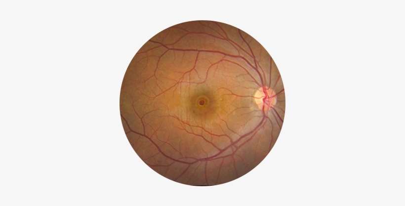 Macular-hole - Alteracion Del Epitelio Pigmentario De La Retina, transparent png download