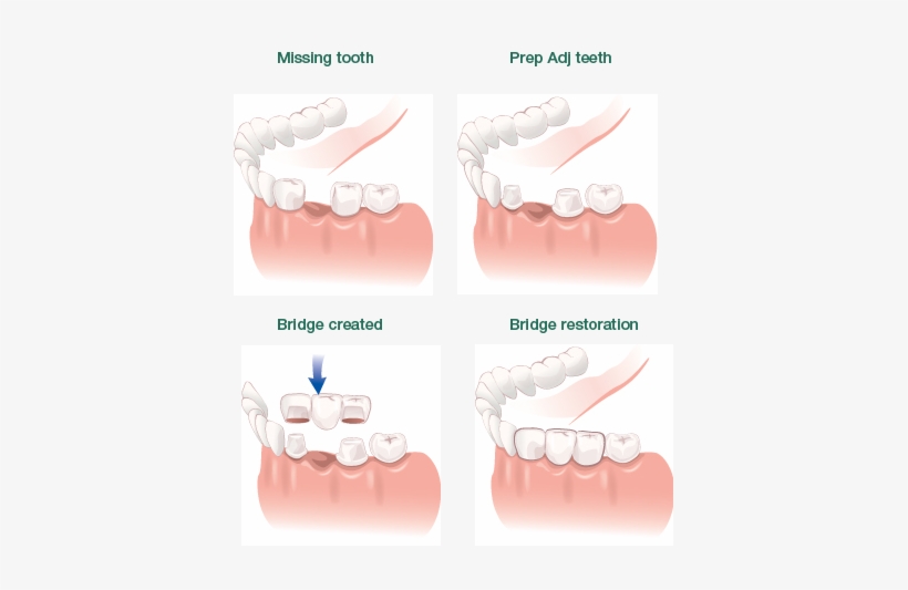 A Bridge May Represent An Excellent Alternative To - Diagram, transparent png download