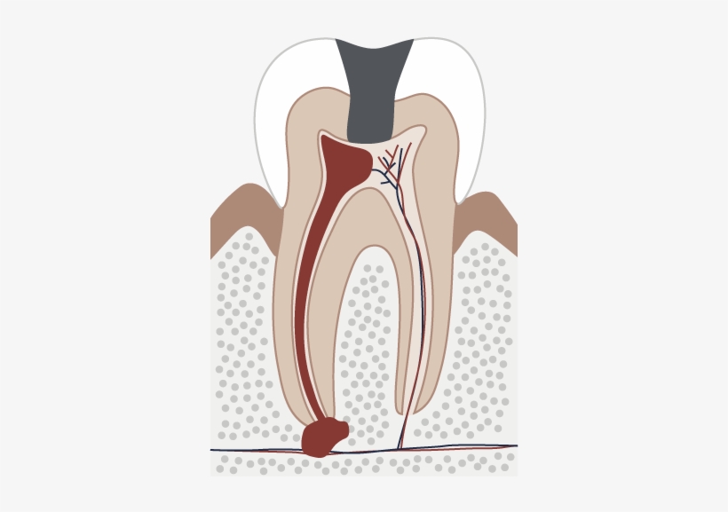 Diagram Of An Inflamed Tooth - Tooth, transparent png download