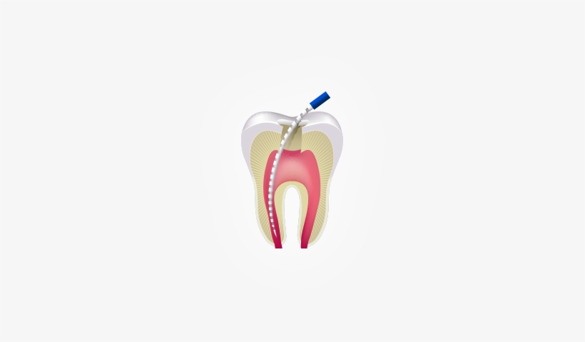 Presentation - Retreatment - Root Canal, transparent png download