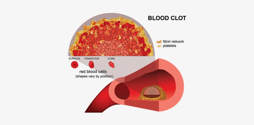 Researchers Look Inside Dangerous Clots With Optical - Blood Clotting Transparent, transparent png download