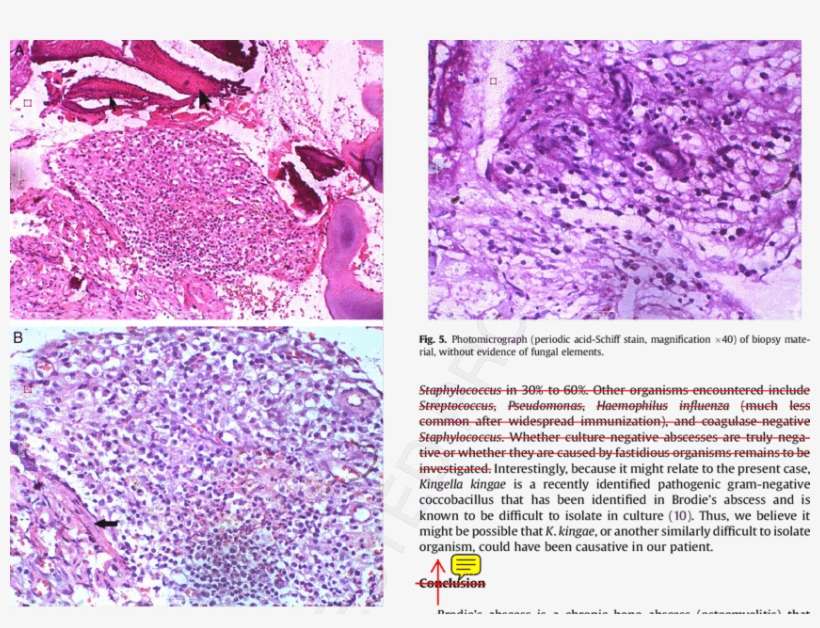 Photomicrographs Showing Dense Infiltrate Of Chronic - Inflammation, transparent png download