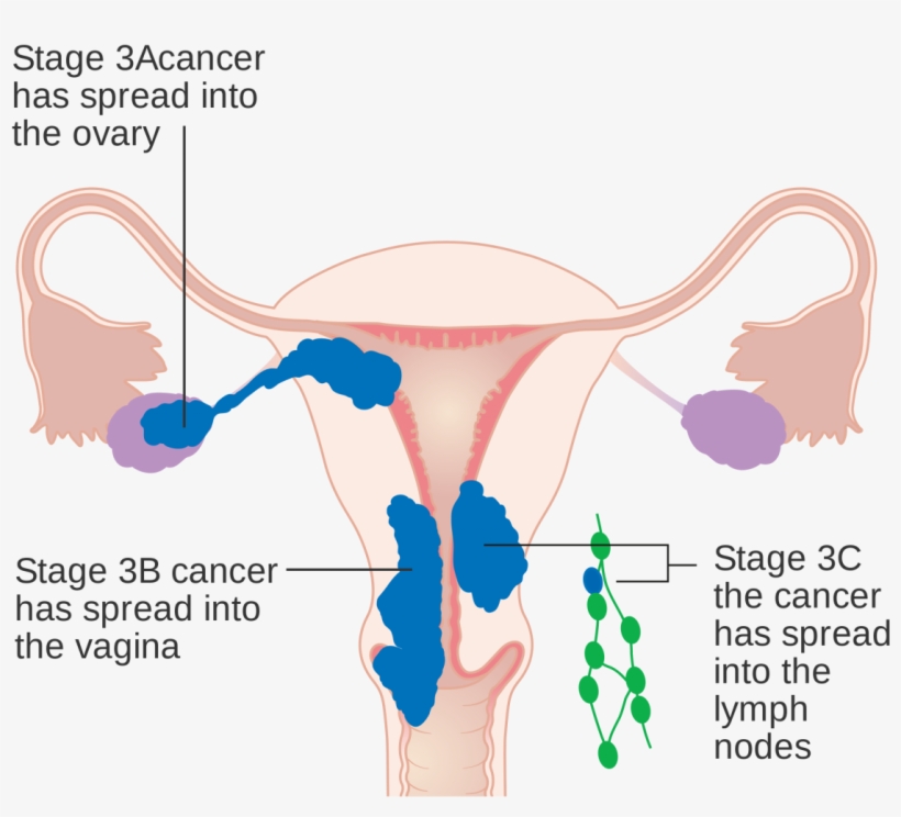 In Stage Iii, The Cancer Has Spread To The Lower Third - Endometrial Cancer Staging Figo Visual, transparent png download