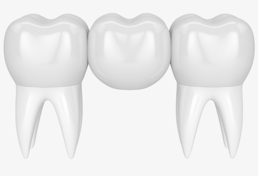 Crowns And Bridges - Bridge, transparent png download