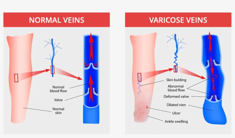 Open Skin Ulcers - Disease Of The Vascular System, transparent png download
