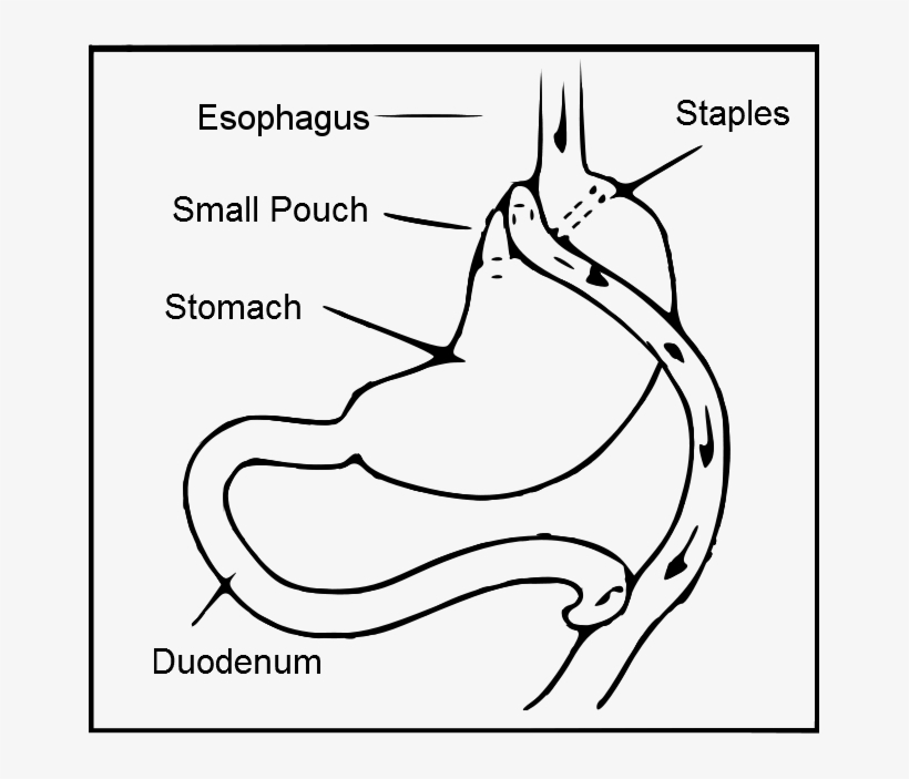 Roux En Y Gastric Bypass, transparent png download