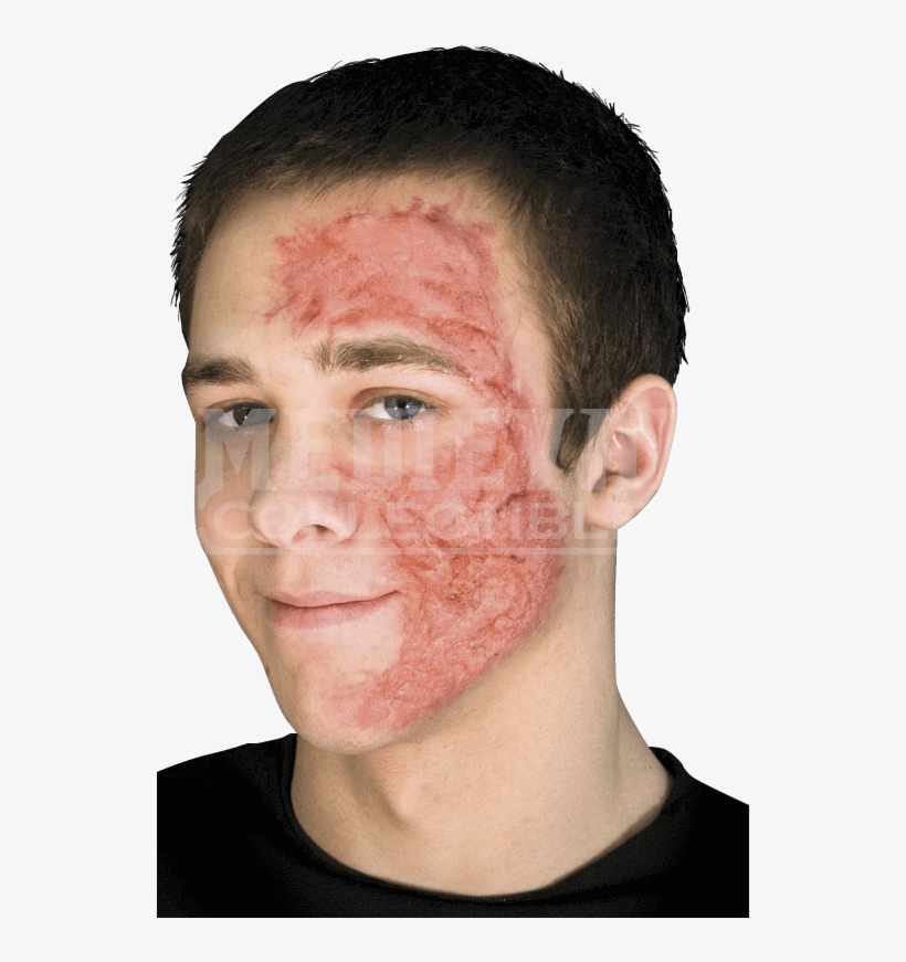 Burn Scar Gel - Burn Scars Latex Prosthesis, transparent png download