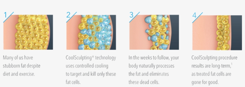 Infinity Medspa Wellness Coolsculpting - Cool Sculpting, transparent png download