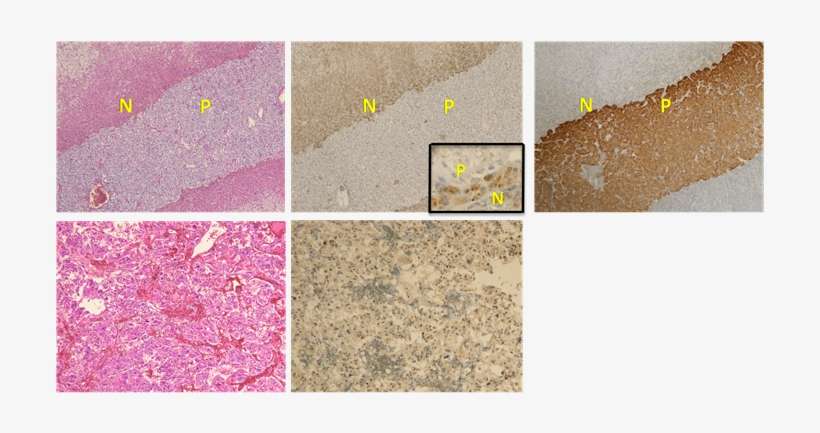 An Nf1 Pheochromocytoma, Lower - Neurofibromin 1, transparent png download