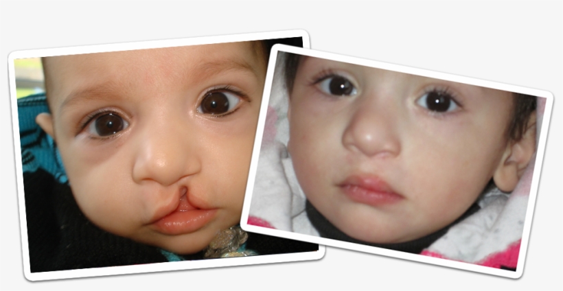 According To The Pclpa Officials One In Every 530 Children - Cleft Lip And Cleft Palate, transparent png download