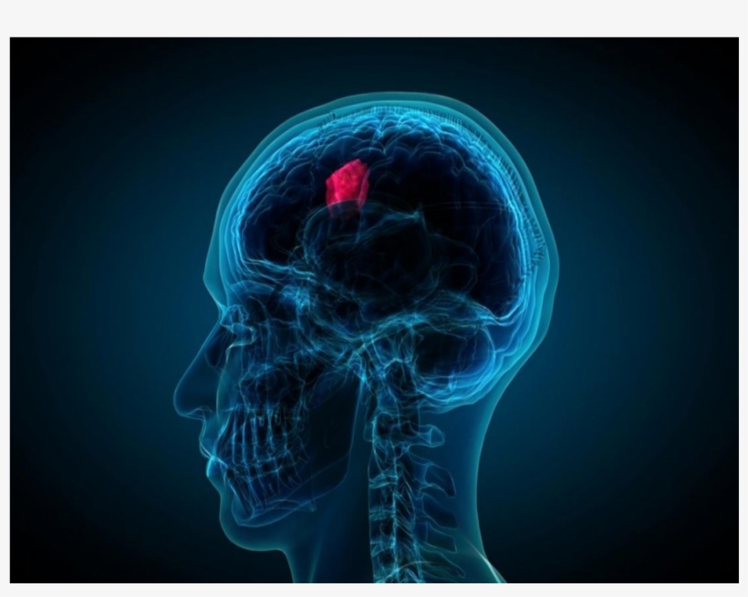 Brain Tumor, transparent png download