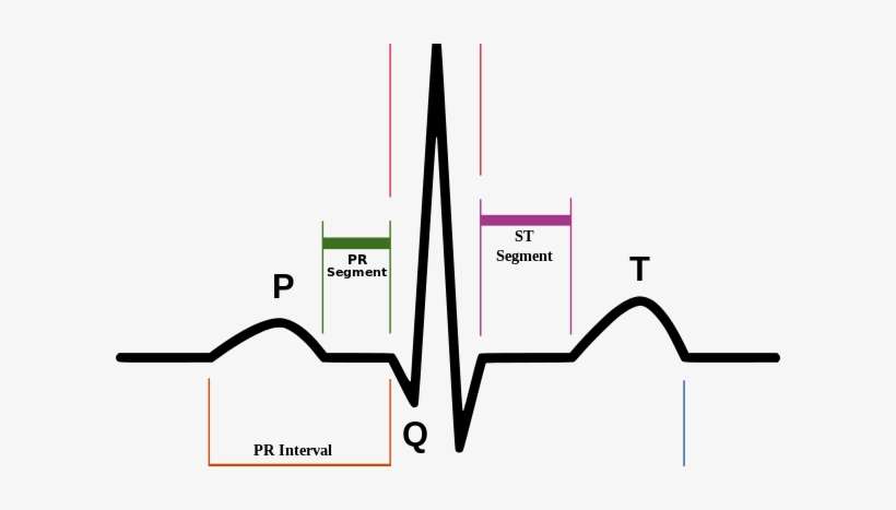 Ecg And Holter Monitoring - Spikes And Dips Ekg, transparent png download