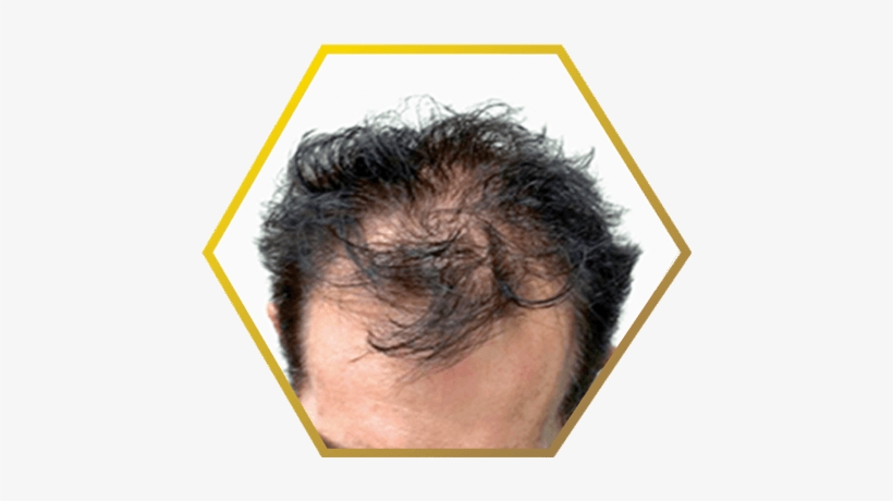 Male Pattern Baldness - Hair Loss, transparent png download