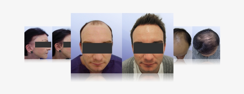 Male Hair Transplant Surgery Before And After Gallery - Melbourne, transparent png download