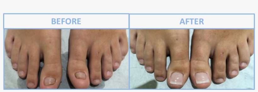 Nail Reconstruction - Fingernail Reconstruction, transparent png download