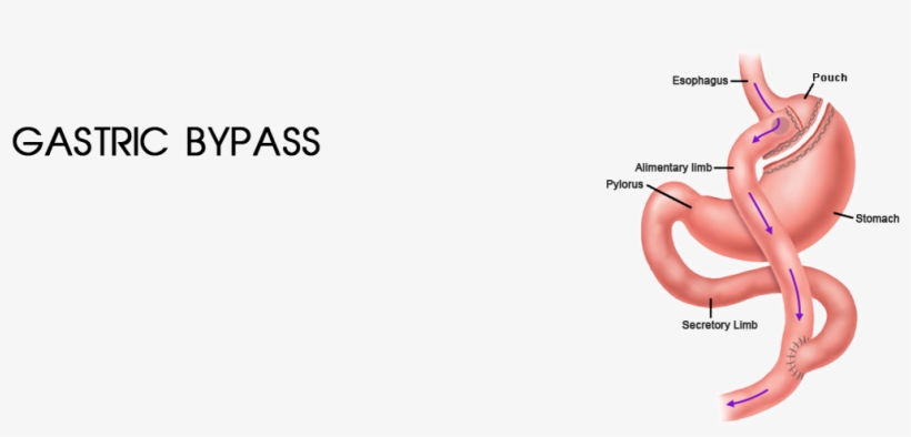 Roux En Y Gastric Bypass, transparent png download