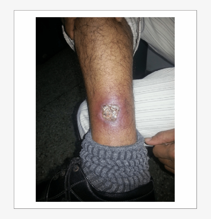A Neglected Case Of Third Degree Muffler Induced Burn - Burn After Two Months, transparent png download