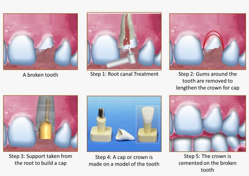 So Are You Afraid Of Having Your Tooth Pulled Out Do - Crown On Broken Tooth, transparent png download