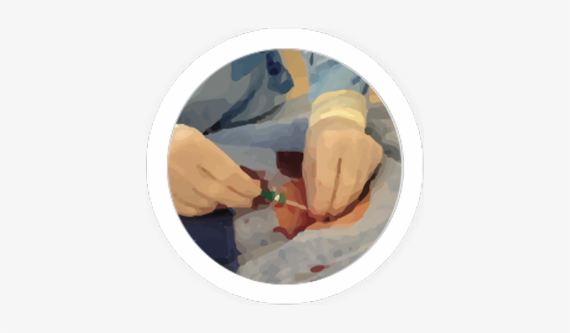 Interventional Radiology Chitosan Bandage Procedure - Bandage, transparent png download