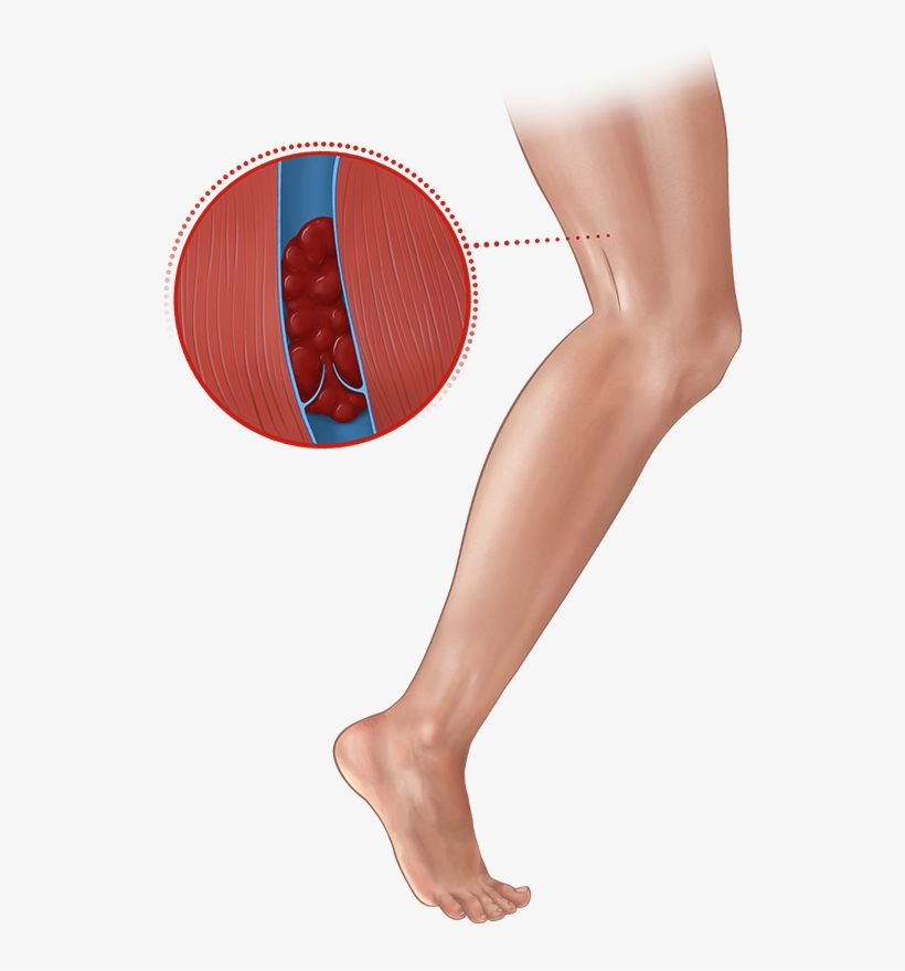 Deep Vein Thrombosis, transparent png download
