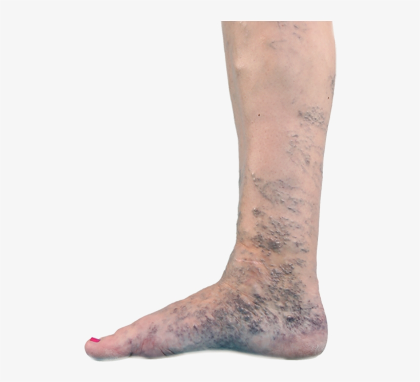 Varicose Veins, transparent png download