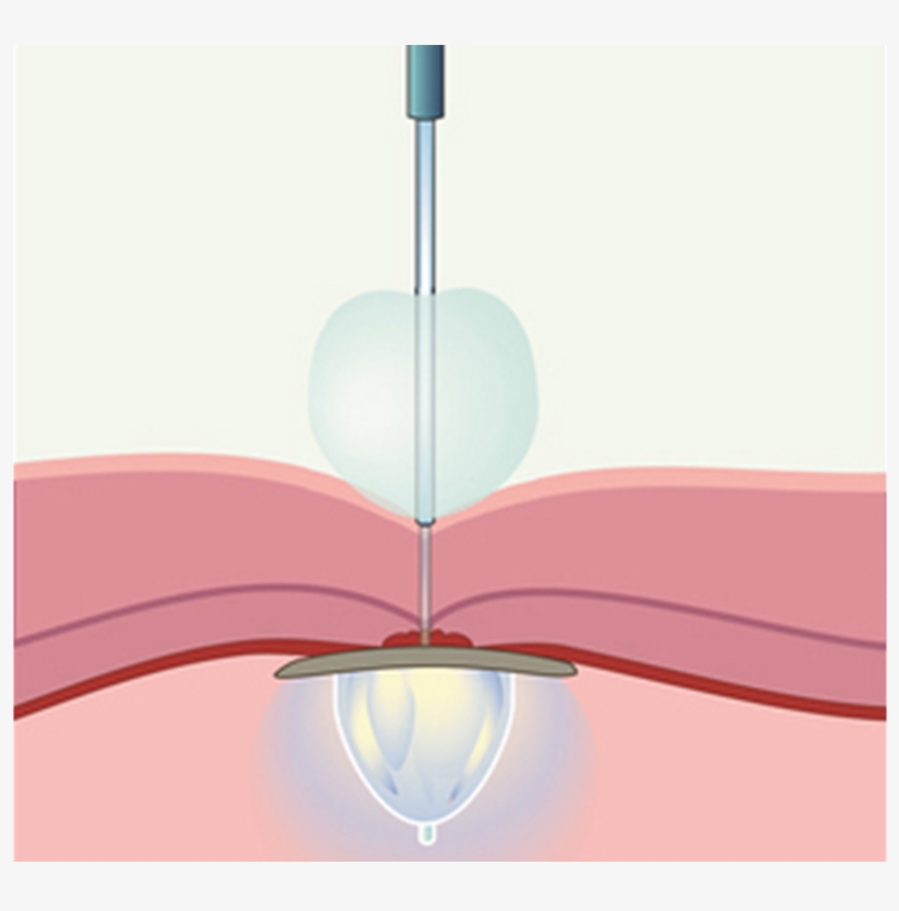 Uv Light And Balloons Can Plug Holes In Your Heart - Heart, transparent png download