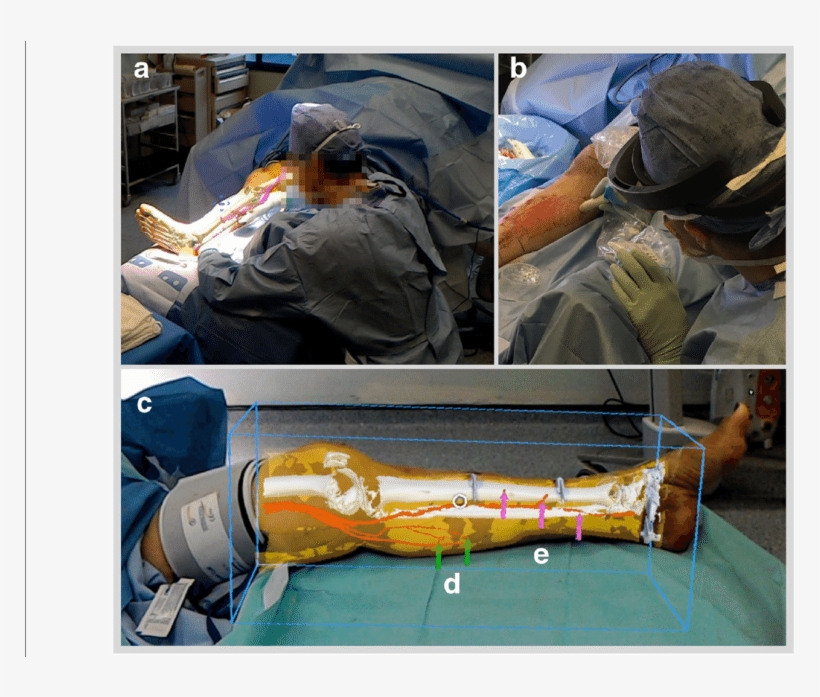 A Case 3 Ar Overlay Of Models As Viewed From Remote, transparent png download