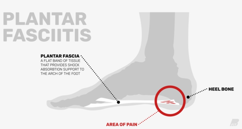 Plantarfasciitisdiagram - Skier Turns, transparent png download